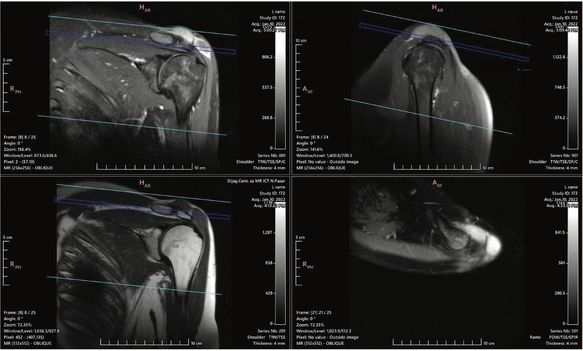 Figure 1. Recurrence of soft tissue tumor – leiomyosarcoma