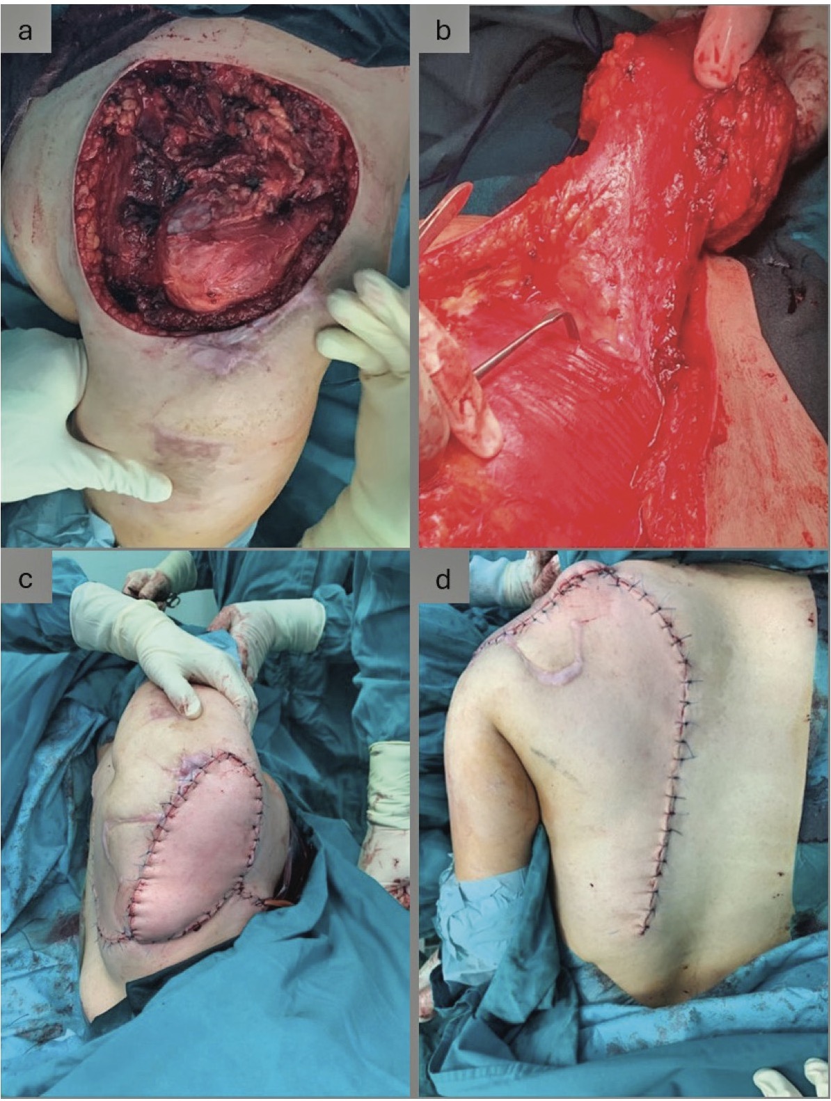 Figure 2. (a-b-c-d). a – wide resection of soft tissue sarcoma in the shoulder region; b – vascular pedicle of the dorsal scapular artery for the lower trapezius musculocutaneous flap; c – recipient site of the shoulder with the lower trapezius musculocutaneous flap; d – donor site of the lower trapezius musculocutaneous flap