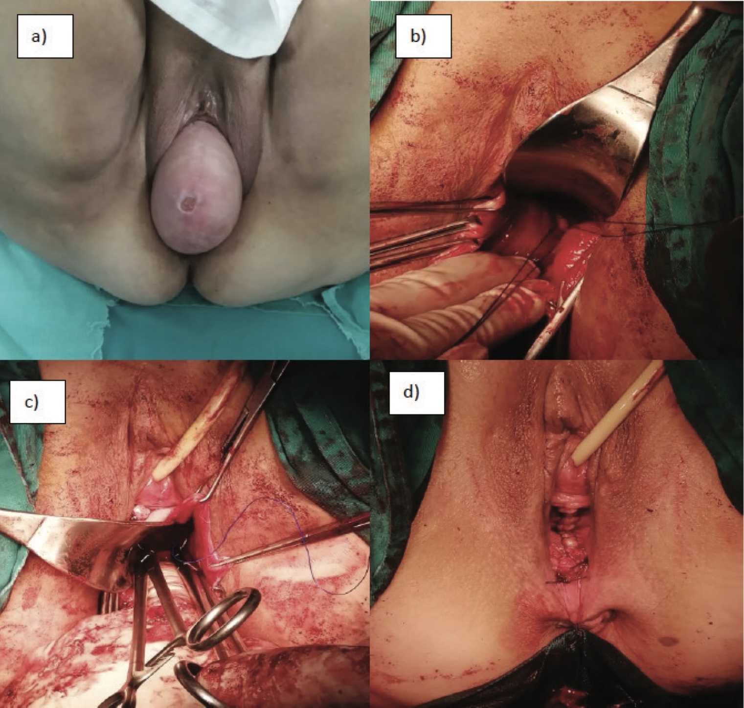 Picture 1. (a) Preoperative status, (right b, left c) sacrospinal fixation, (d) final result
