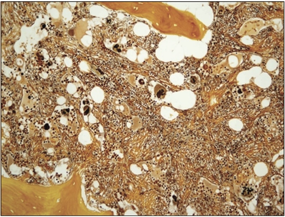 Picture 1. MF-3, Gordon Sweet x200, Dense reticulin fibers, and bundles of collagen