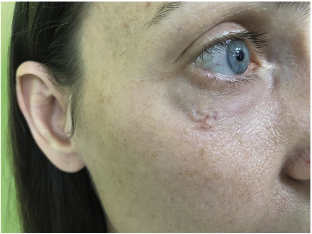 Picture 1. Preoperative image of a 38-year-old female patient showing the right lower eyelid with visible slight swelling indicative of a subcutaneous parasite (Dirofilaria spp.). The patient experienced discomfort and the sensation of movement within the eyelid, correlating with parasitic presence, before surgical removal