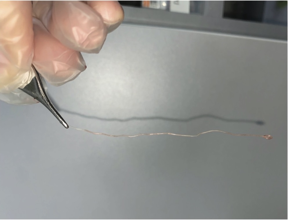 Picture 2. A thin, elongated parasitic organism (Dirofilaria spp.) is shown being held with tweezers after surgical extraction. The worm-like structure is 12 centimeters long