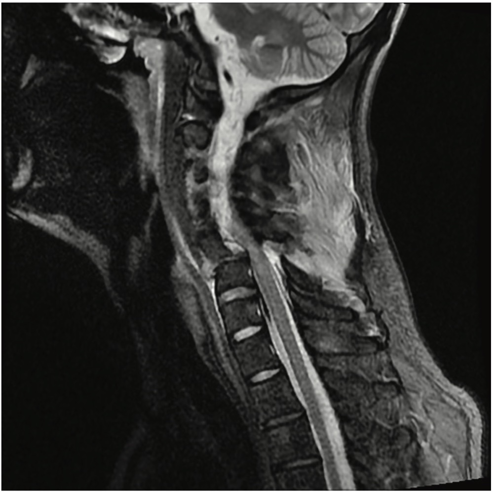 Picture 1. MRI of the cervical spine: spondylolisthesis at the C5–C6 level, grade II/III, left dorsolateral extrusion of the C5–C6 intervertebral disc, as well as spinal canal stenosis with medullary compression and signs of myelopathy, along with fractures of the left lamina of C5 and the left transverse process of C6