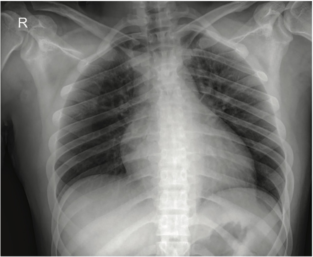 Picture 2. Chest X-ray on the day of admission to the COVID hospital Batajnica, normal findings