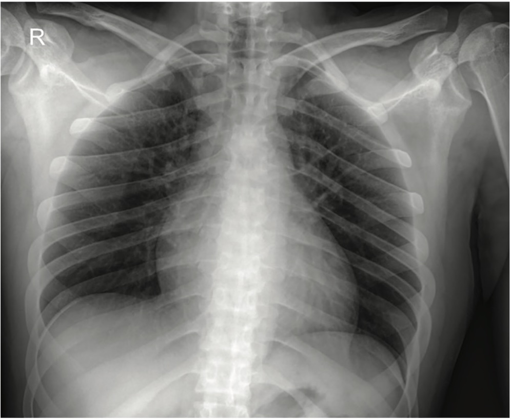 Picture 3. Follow-up chest X-ray before discharge from the COVID hospital Batajnica UKCS, normal findings