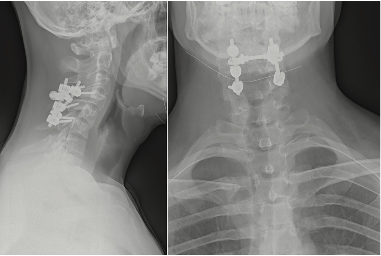 Picture 4 i 5. X-ray of the cervical spine after successful surgery and stabilization of cervical vertebrae