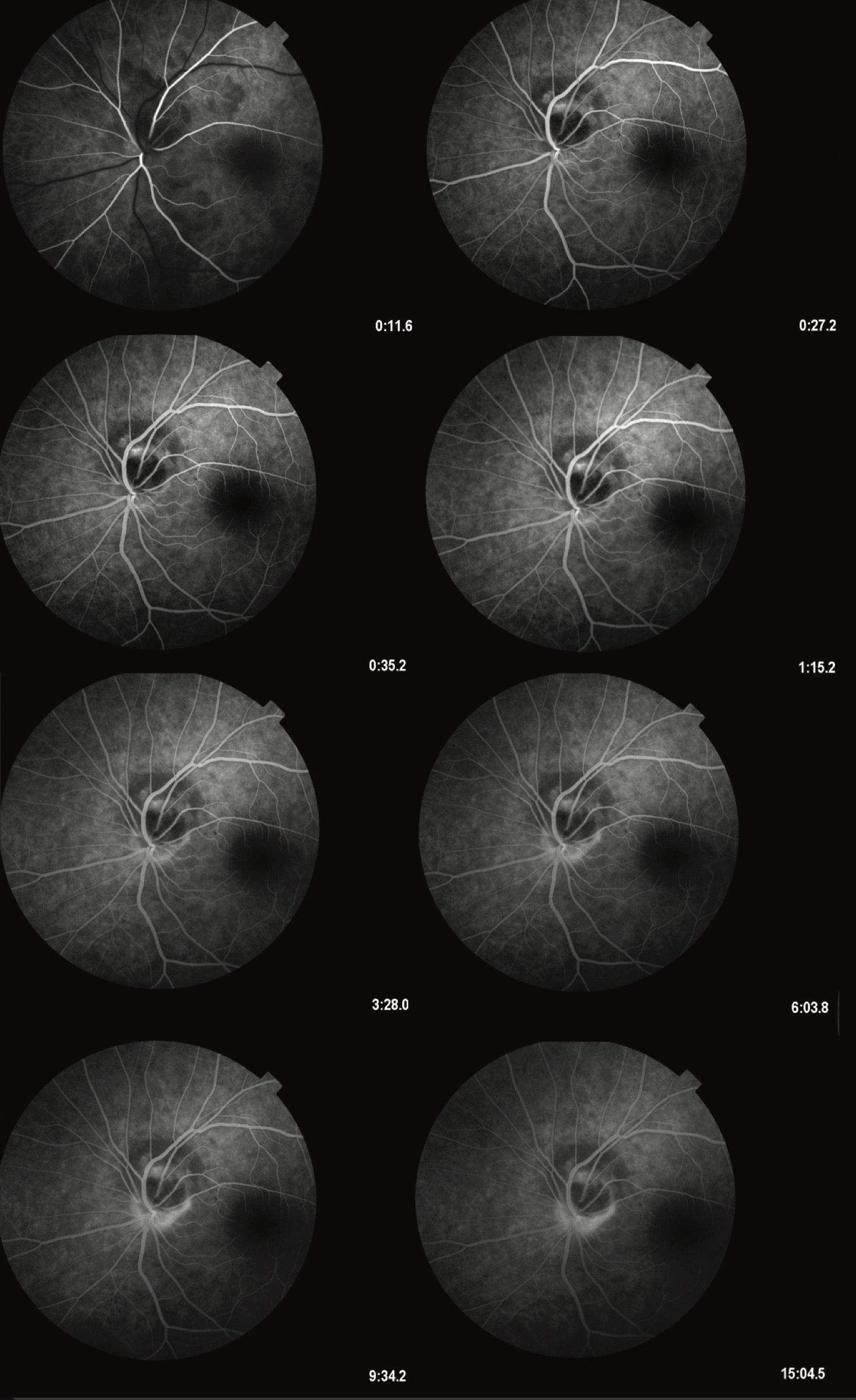 Slika 2. Ova slika prikazuje seriju snimaka fluoresceinske angiografije (FA) melanocitoma glave optičkog nerva, praćenog jukstapapilarnim horoidalnim nevusom. Angiografski niz ilustruje odsustvo curenja ili prebojavanja melanocitoma, što je u skladu sa njegovom benignom prirodom. Lezija se vidi kao tamna, jasno ograničena oblast na optičkom disku, koja blokira fluorescenciju. Pored melanocitoma, horoidalni nevus se prikazuje kao hipofluorescentna oblast