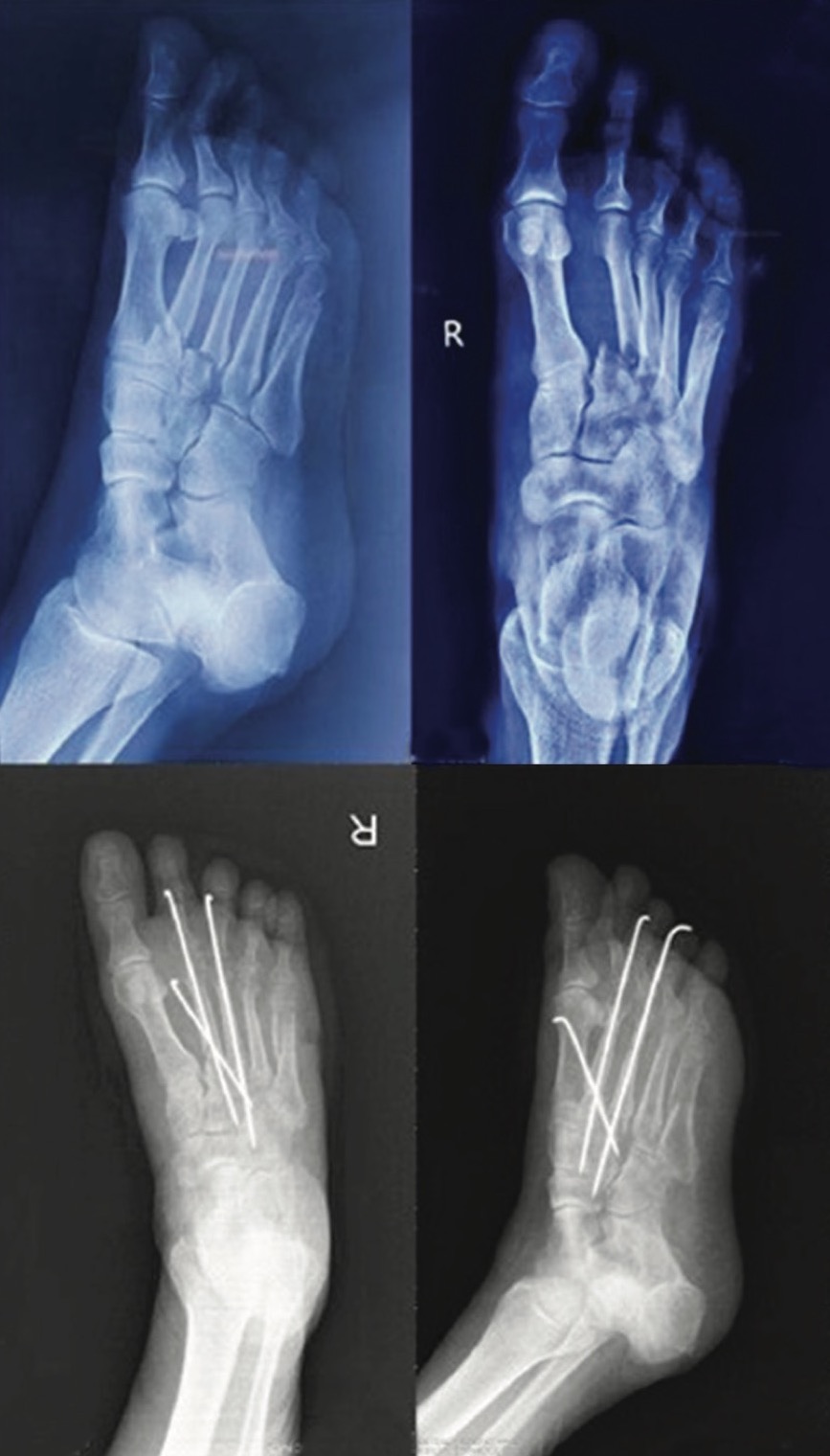 Figure 1. Radiography of the foot after injury and after operative