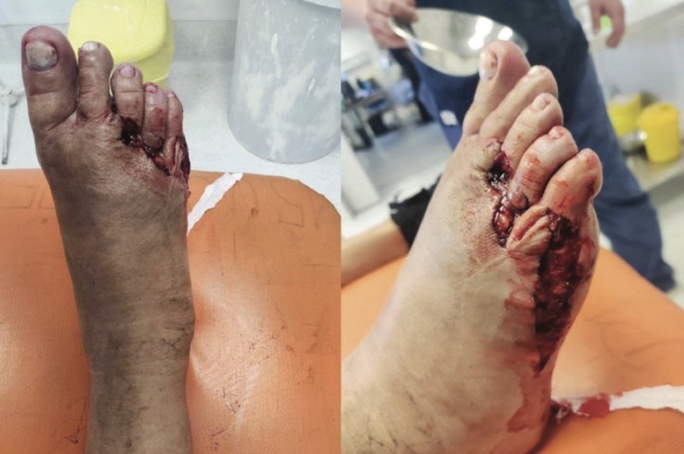 Figure 2. The foot after injury
