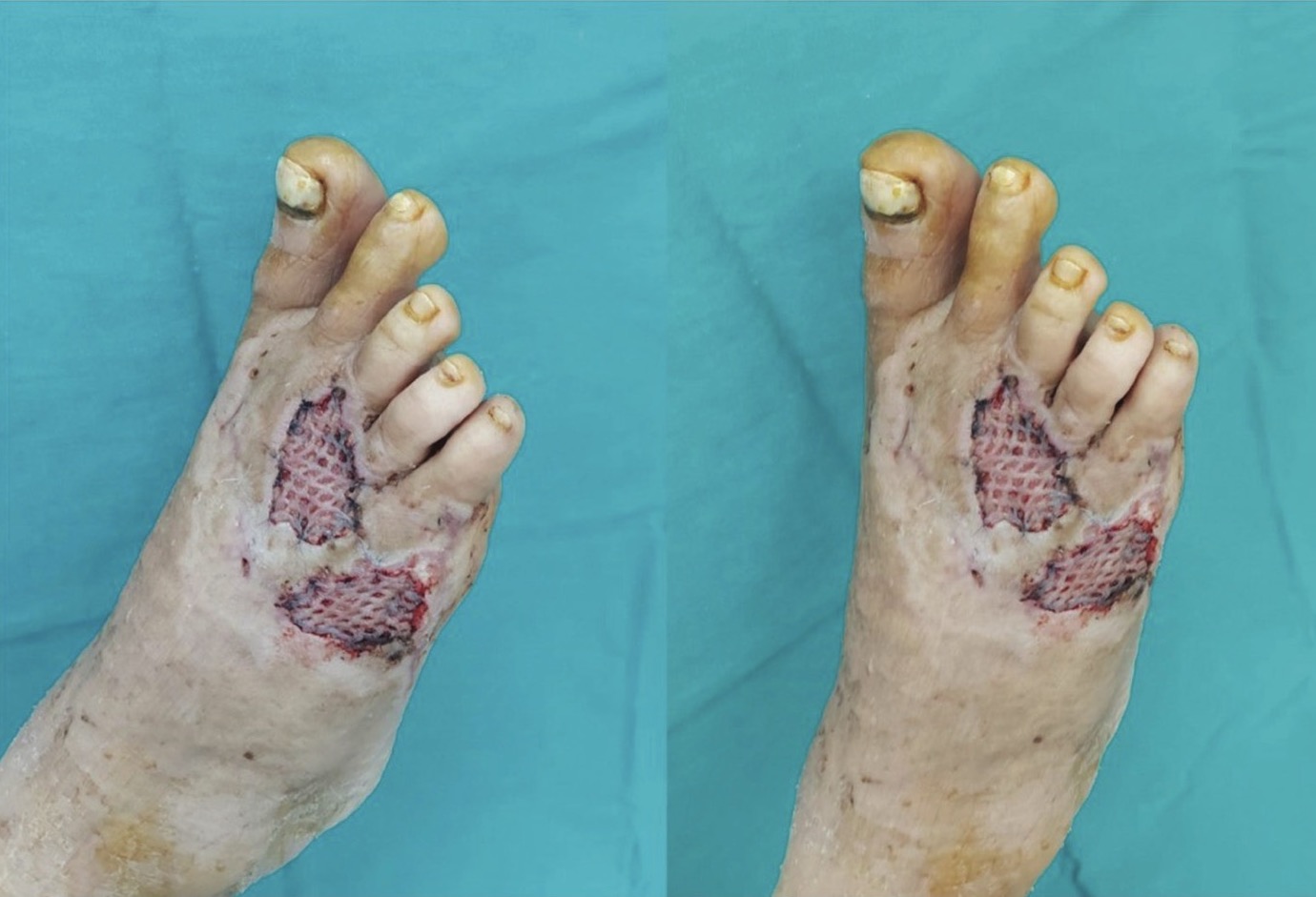 Figure 4. Foot with Thiersch transplant
