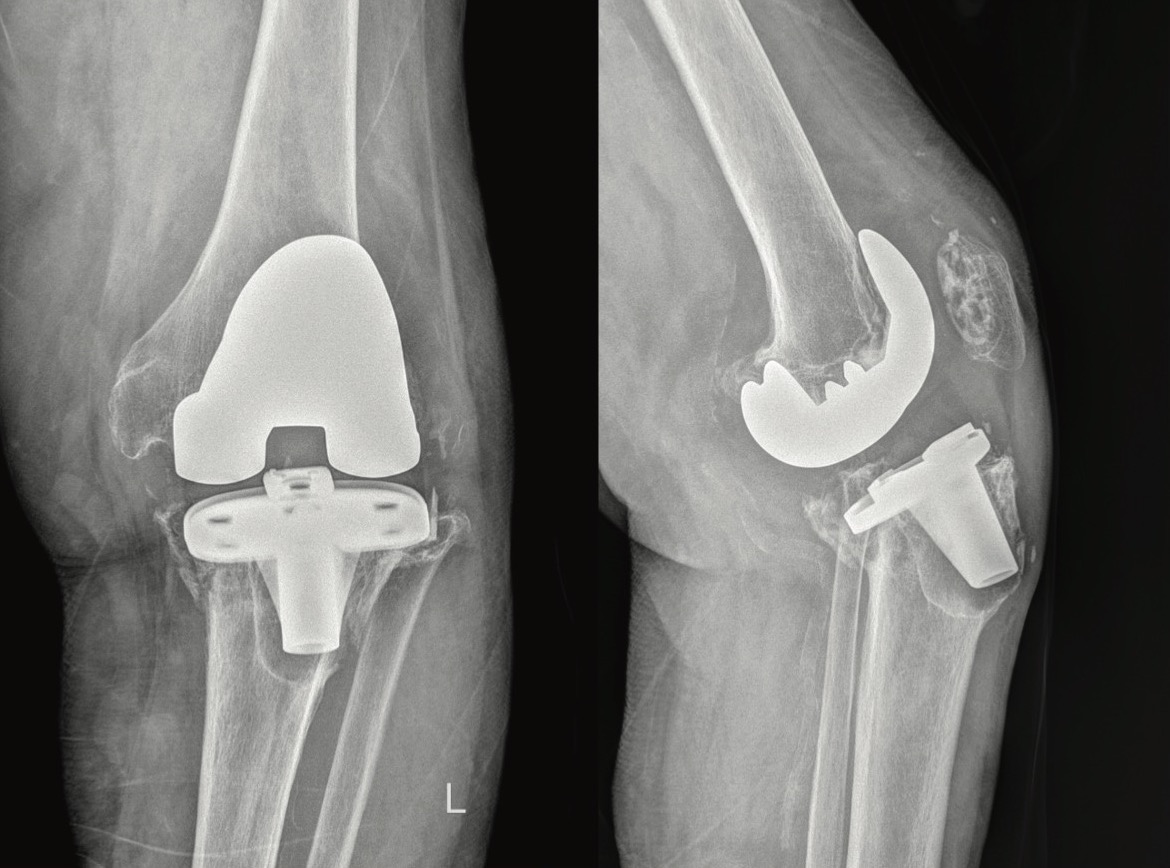 Figure 3. Preoperative left knee AP and lateral view of 73-year old female patient who suffered from proximal tibia periprosthetic fracture following fall from standing height