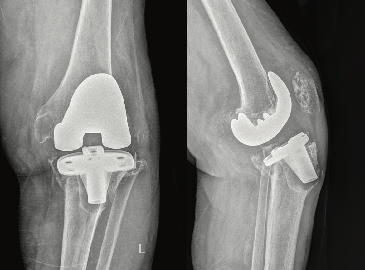 Figure 4. Postoperative AP and lateral views of the same patient at 2-year follow-up, showing no signs of component malalignement or loosening
