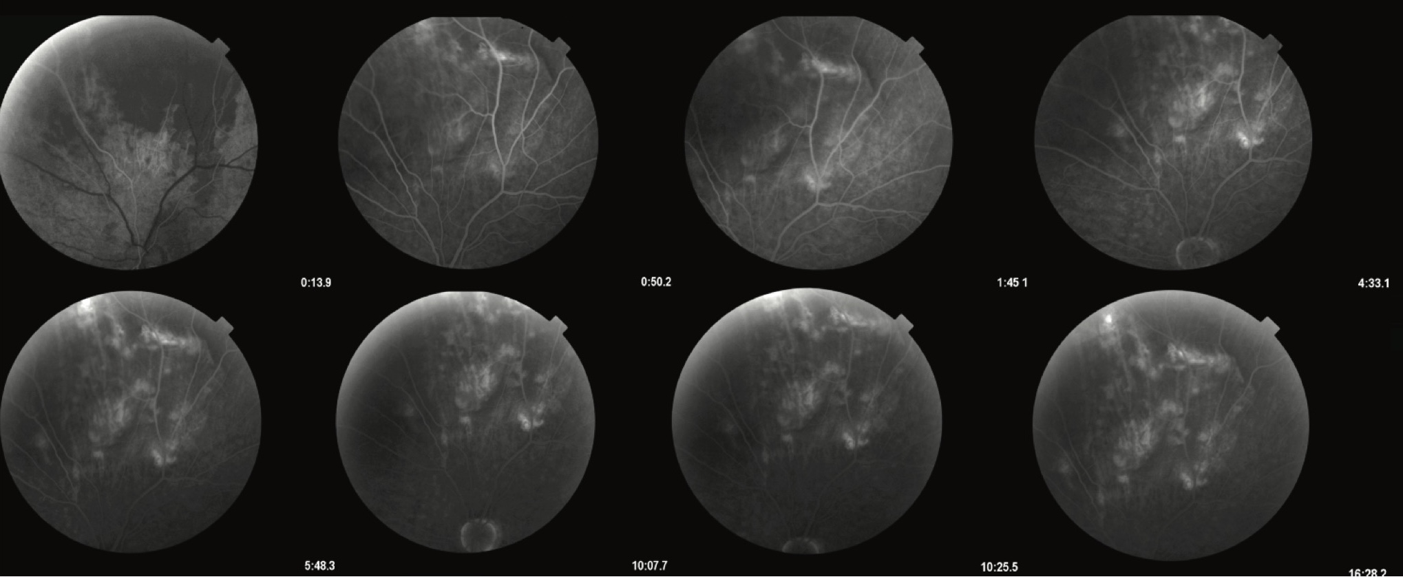 Slika 2. Fluoresceinska angiografija levog oka prikazuje hipofluorescentnu subretinalnu leziju lokalizovanu suprapapilarno, između gornjih vaskularnih arkada. Lezija ne pokazuje prisustvo curenja ili zadržavanja boje ni u ranim ni u kasnim fazama, što je u skladu sa benignim, avaskularnim procesom kao što je sklerohoroidalna kalcifikacija
