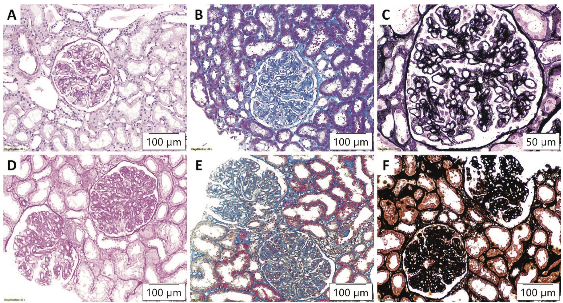 Figure 1. Changes in glomeruli on light microscopy in primary (A) Periodic acidSchiff (PAS), x200, (B) Masson’s trichrome (MTS), x200, (C) Jones methenamine silver (JMS), x400; and secondary membranous nephropathy, with evident endocapillary hypercellularity (D) PAS, x200, (E) MTS, x200, (F) JMS, x200