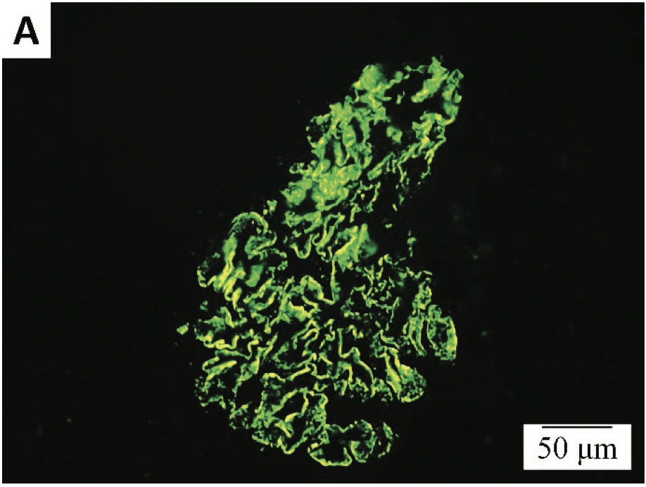 Figure 2. Immunofluorescence microscopy findings: fine granular deposits of (A) IgG and (B) C3 along the glomerular basement membrane, x400