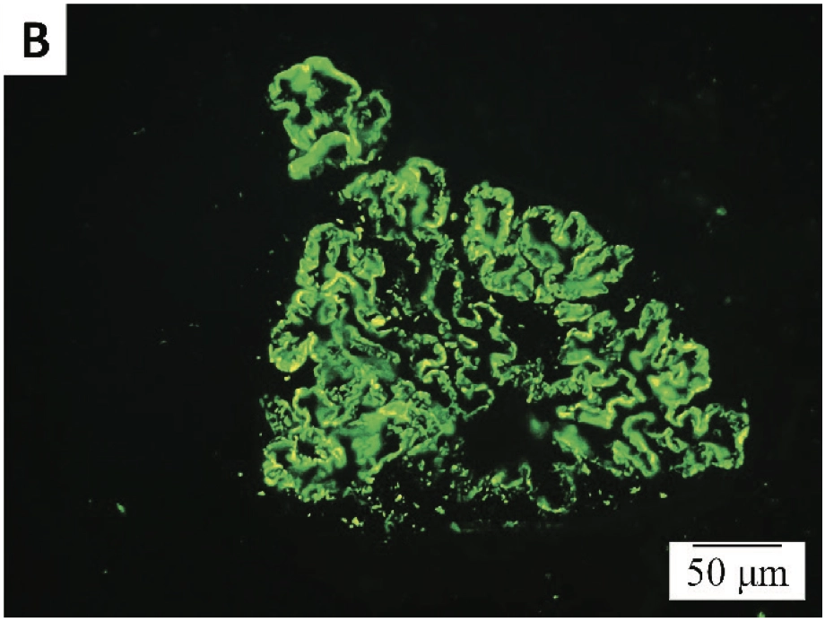 Figure 2. Immunofluorescence microscopy findings: fine granular deposits of (A) IgG and (B) C3 along the glomerular basement membrane, x400