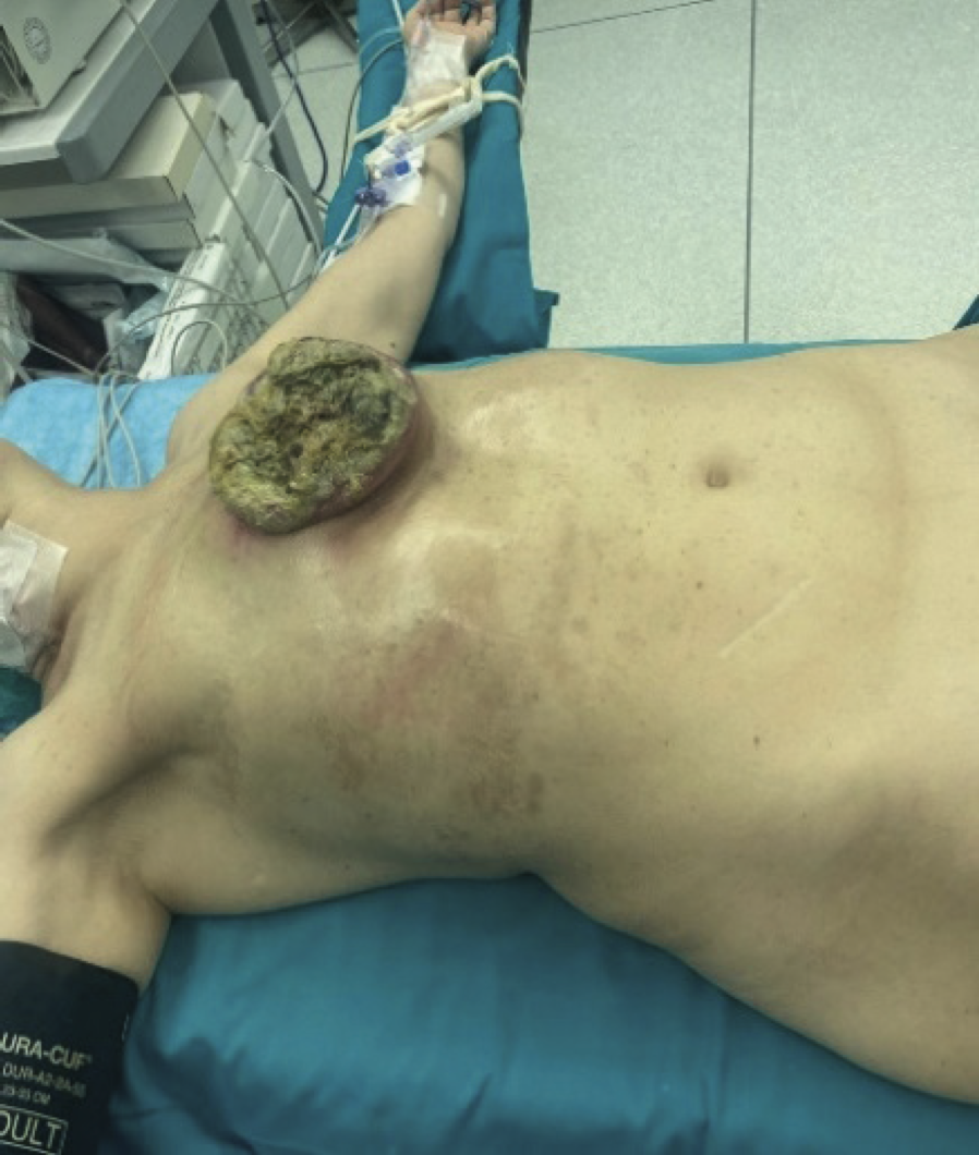 Slika 1. Egzulcerišući purulentno secernirajući tumor prednjeg zida grudnog koša pre prve operacije